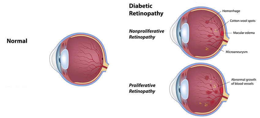 diabetic rentinopathy diagram