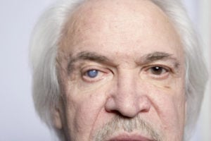 older man face with cloudy right eye