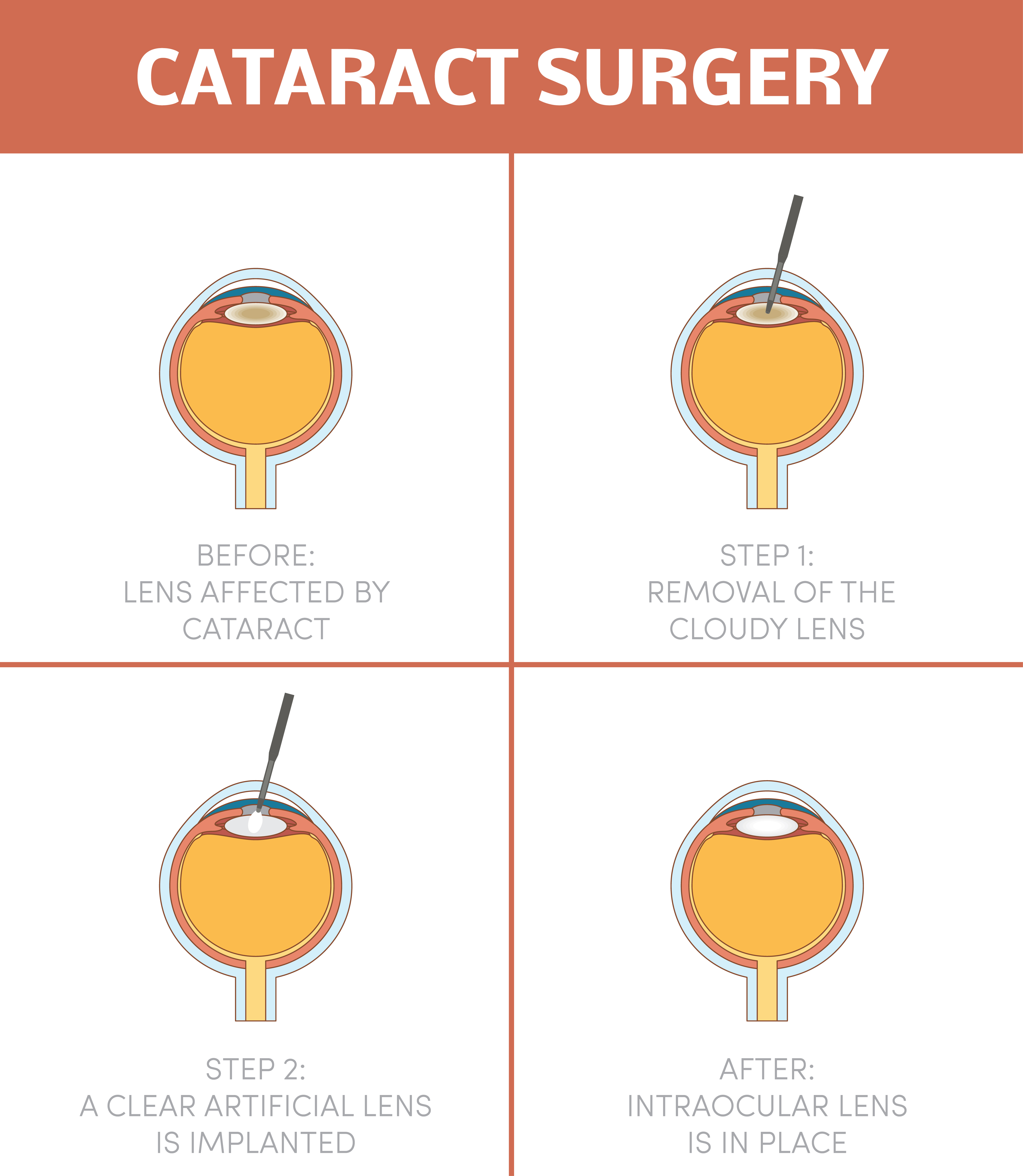 cataract surgery steps diagram
