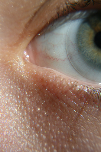 LASIK eye surgery vs Cataracts