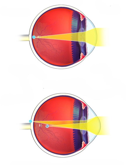 problema viziunii astigmatism scăderea pâlpâirii vederii