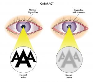 cataracts